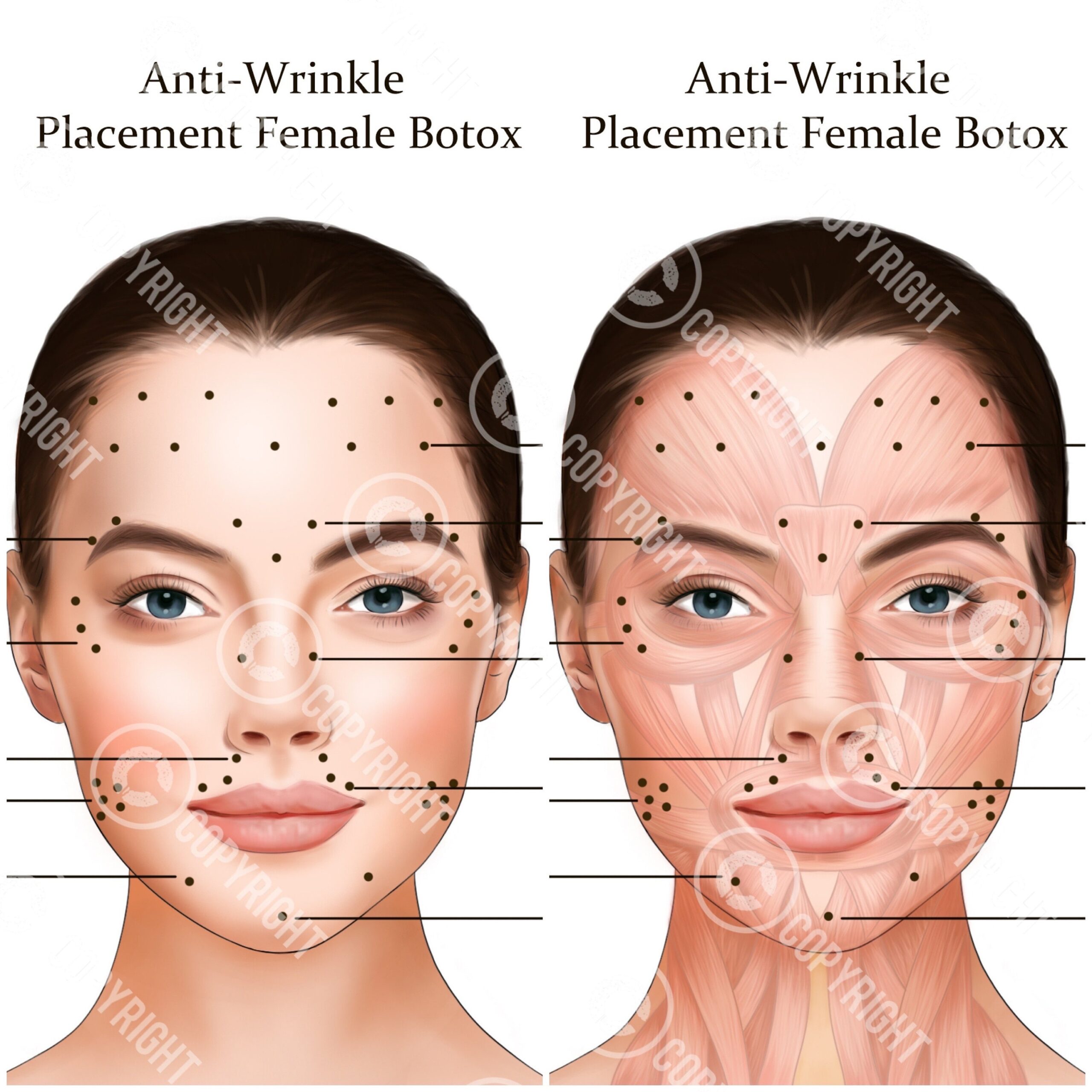 Printable Botox Injection Face Map Etsy Australia