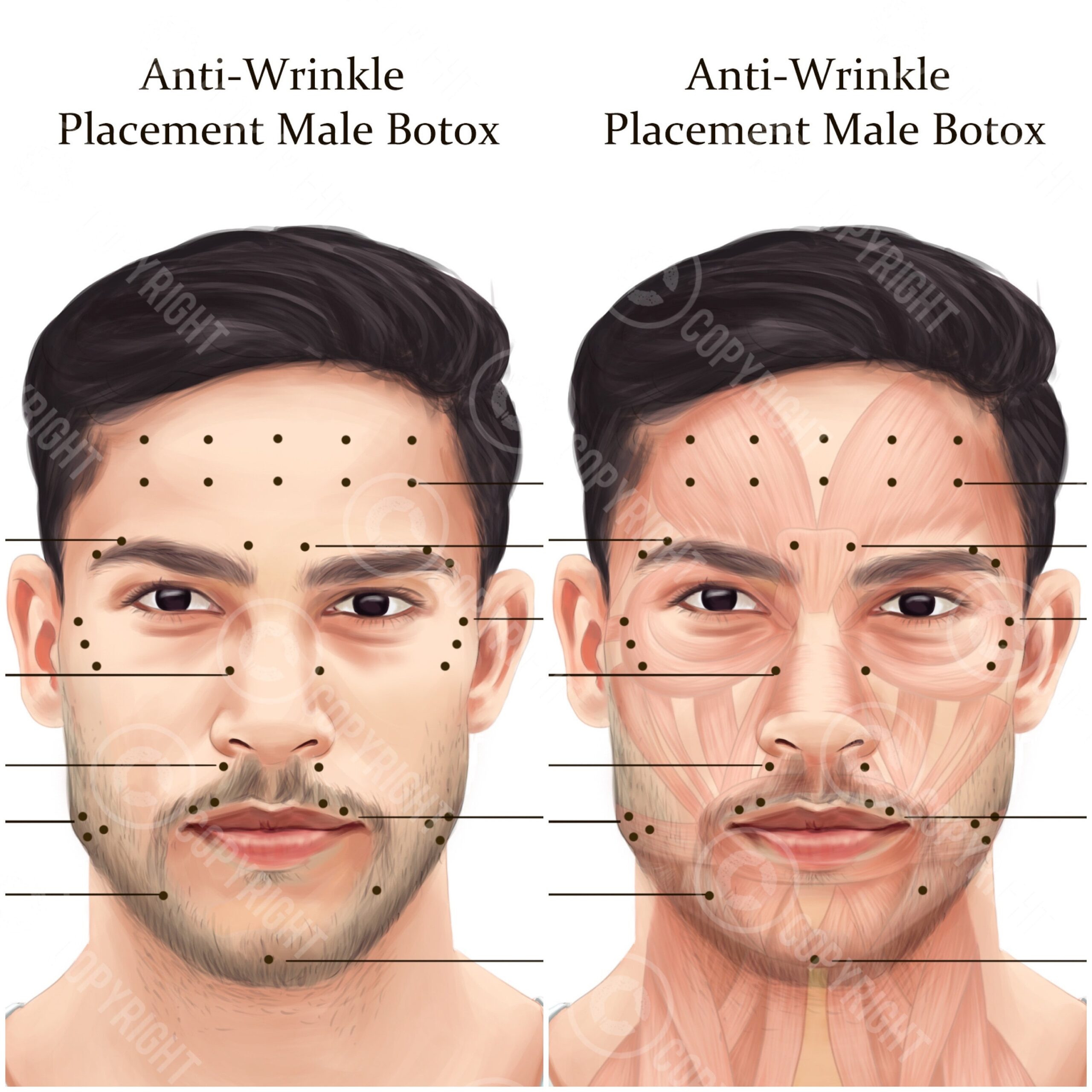 printable botox injection face map
